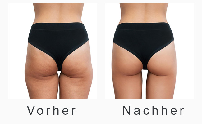 LPG-Lipomassage-Ergebnisse-Hauststraffung-gegen-Cellulite